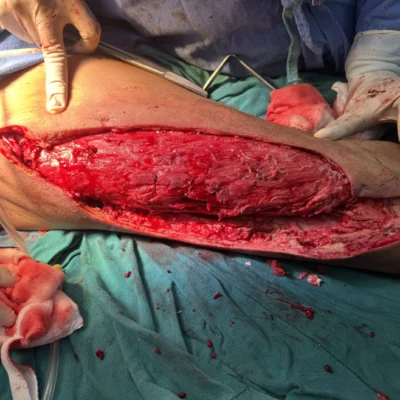 Open wound treated by Curific Implnats Npwt Kit