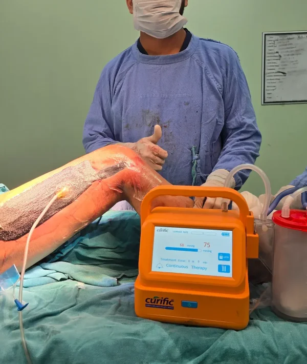 Curific NPWT Kit in action by Dr Rukhsar Ahmed in Delhi