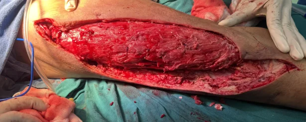 Open wound treated by Curific Implnats Npwt Kit